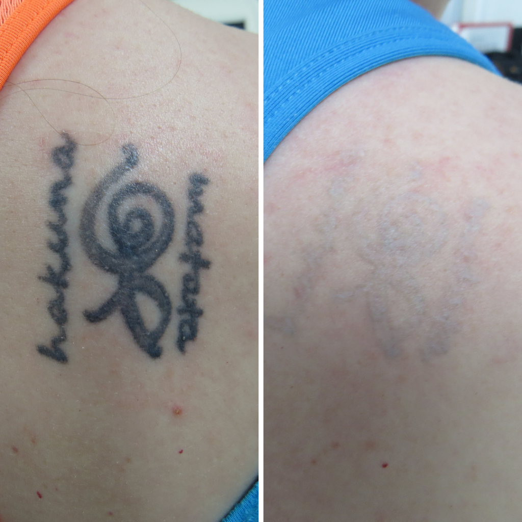 Laser tattoo removal  Auckland Dermatology
